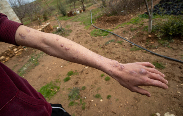 Le bras d’Ahmed, 16 ans, porte les séquelles d’une mine qui a explosé en octobre dernier, à Kobané. (Ali Ali) 
