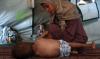 Gaza: la malnutrition touche un quart des jeunes enfants examinés par MSF la semaine dernière