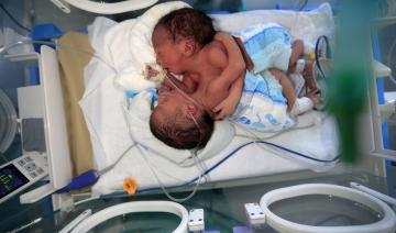 Yémen: des bébés siamois attendent une opération à l'étranger