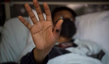 L'Indonésie enregistre son premier cas de variole du singe